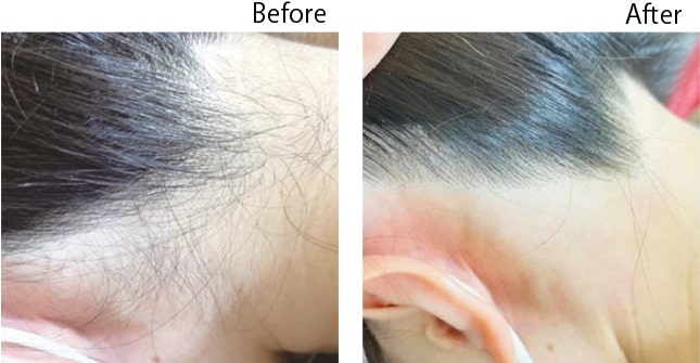 うなじ脱毛のビフォーアフター