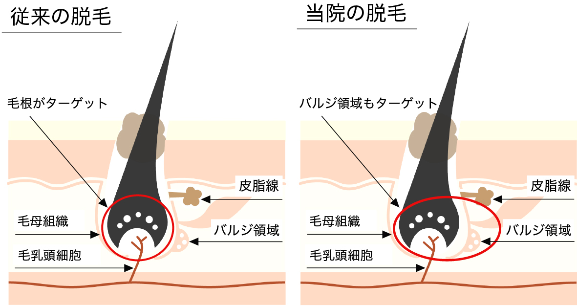 毛根のバルジ領域