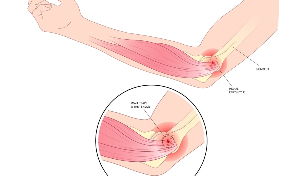 肘の内側のイラスト