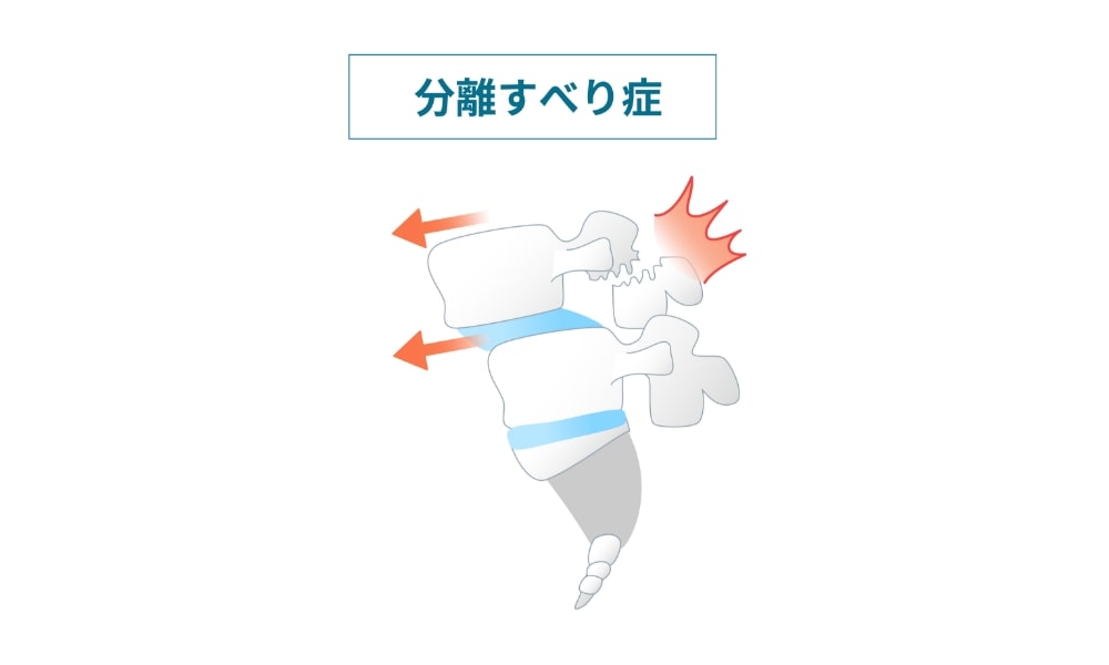 腰椎分離すべり症のイラスト