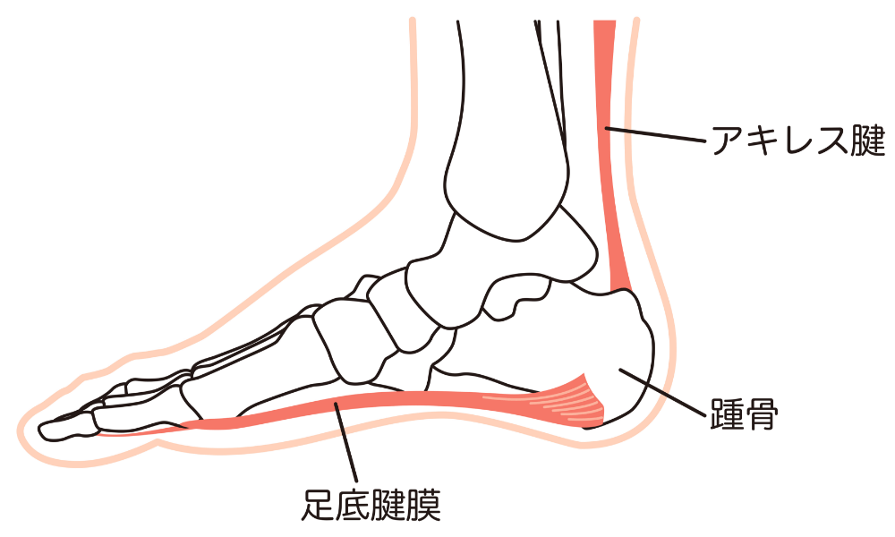 足底腱膜炎